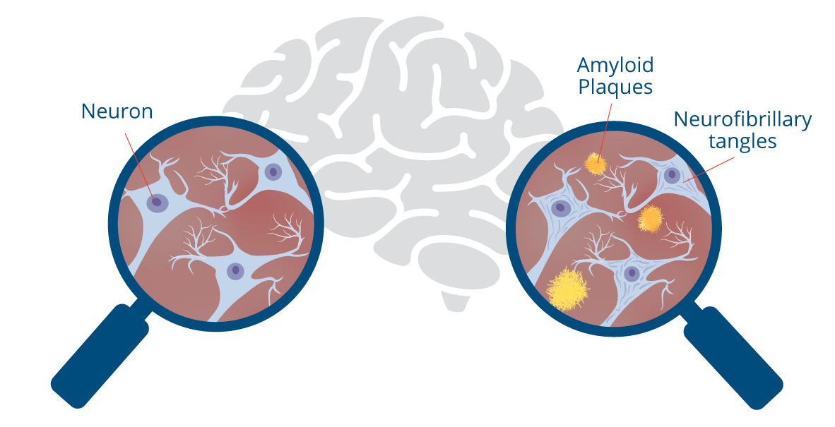 Brain diagram showing Plaques and Tangles