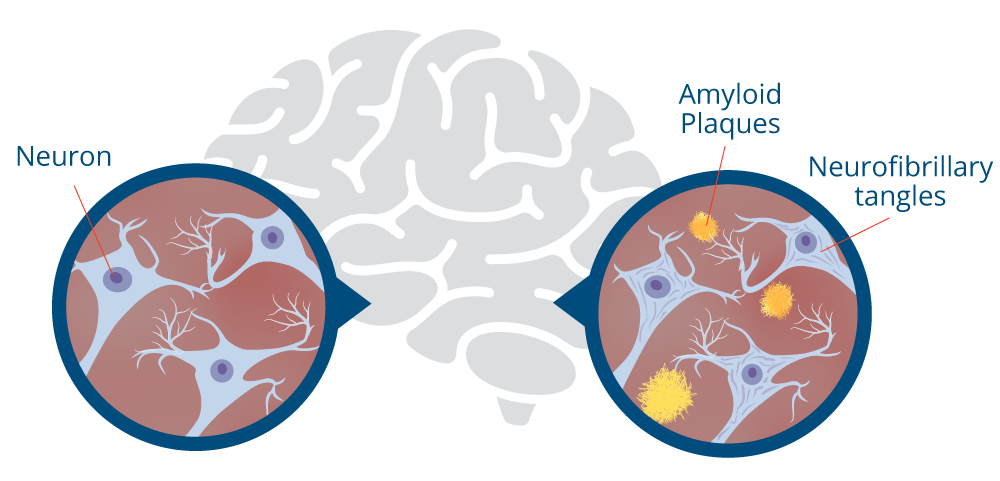 Brain diagram showing Plaques and Tangles